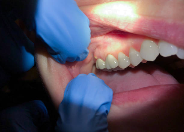 Best Emergency Dentist for Lost Fillings or Crowns in Western Lake, TX