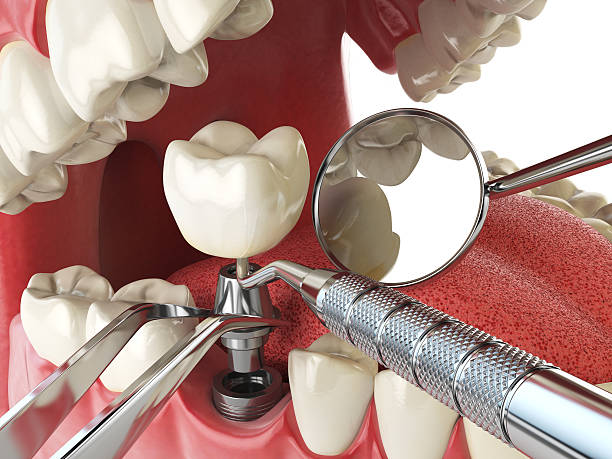 Best Emergency Root Canal Treatment in Western Lake, TX